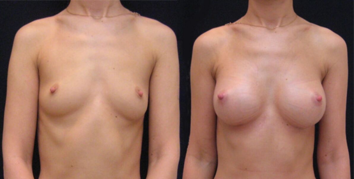 borst voor en na endoscopische augmentatie