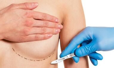 Submammarische toegang tot borstvergroting met implantaten