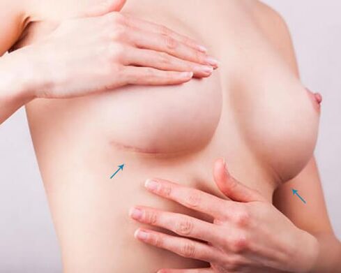 Borstvergroting met implantaten