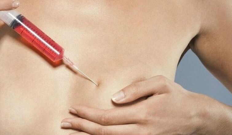 Borstvergroting met hyaluronzuurinjecties