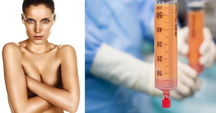 lipofilling als methode voor borstvergroting